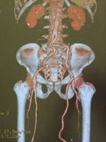 腹部大動脈瘤3D画像