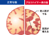 認知症