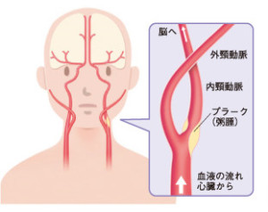 頚動脈