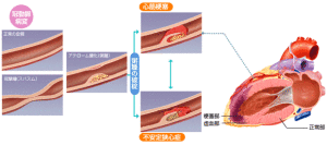 心筋梗塞