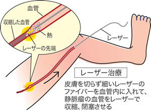 レーザー